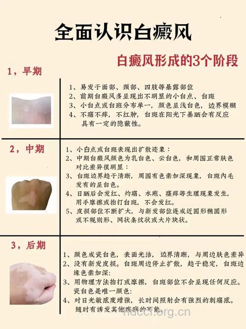 生活中有哪些常见的白癜风病因