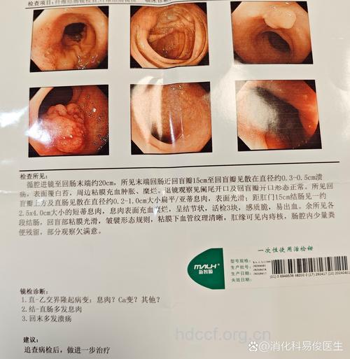 直肠息肉会癌变吗