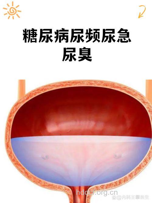 糖尿病患者排尿不畅可能是神经病变