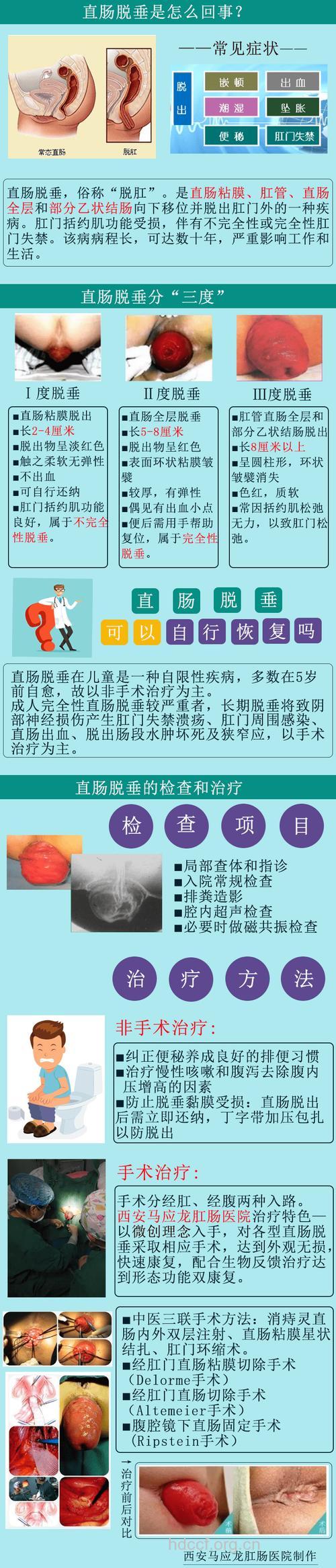 专家解析直肠脱垂的常见病因