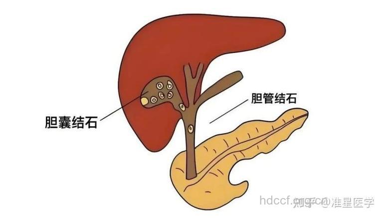 糖尿病合并胆结石非偶然现象