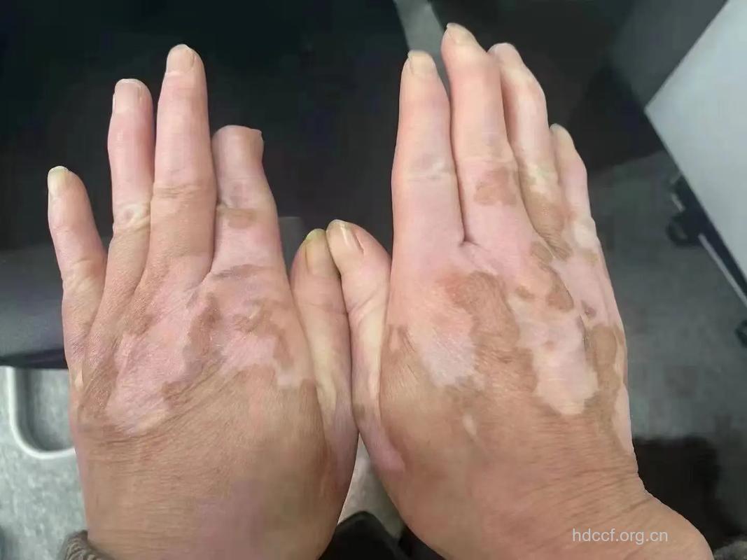 真实治疗是治愈白癜风的根本