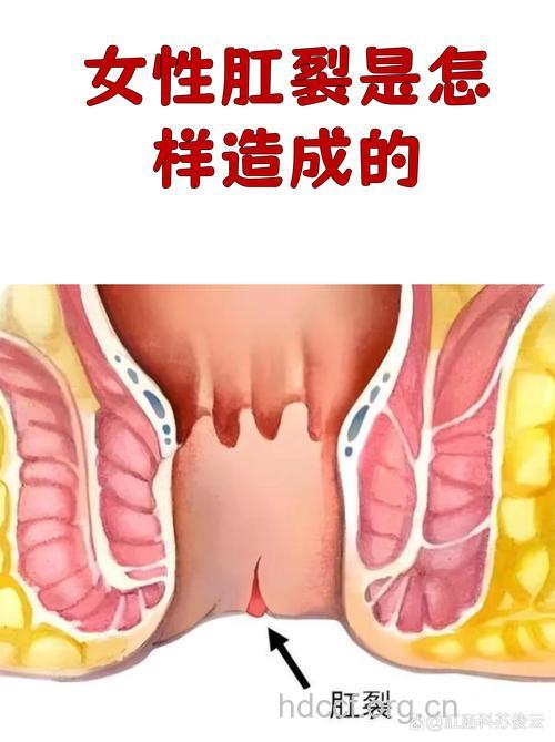 为何青年妇女易肛裂?