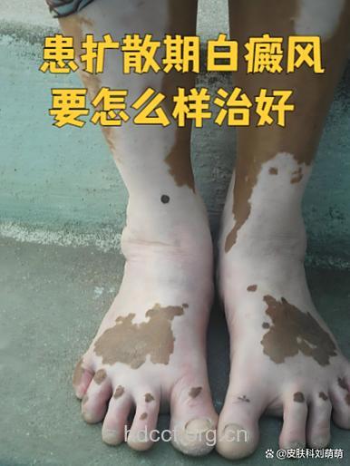 精神性抑郁患者更易患白癜风