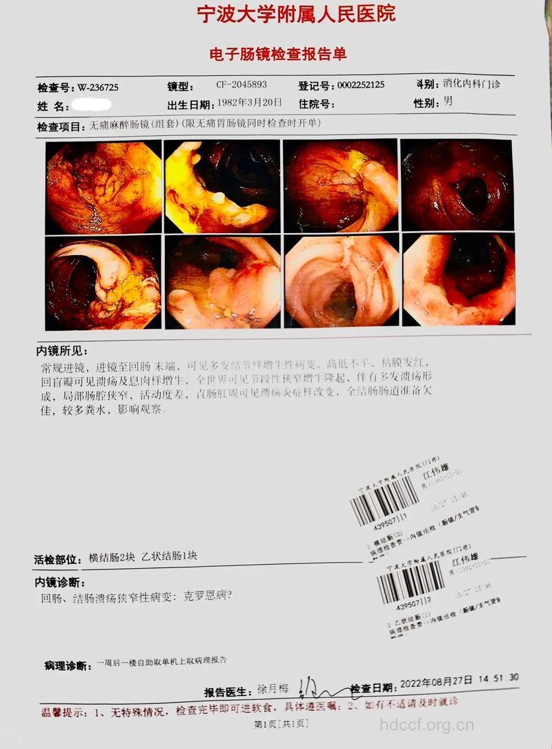 克罗恩病需要做哪些检查?