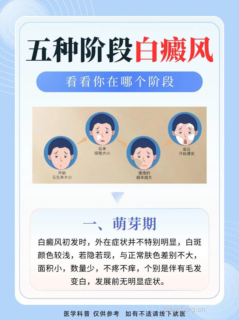 你对白癜风了如指掌了吗？