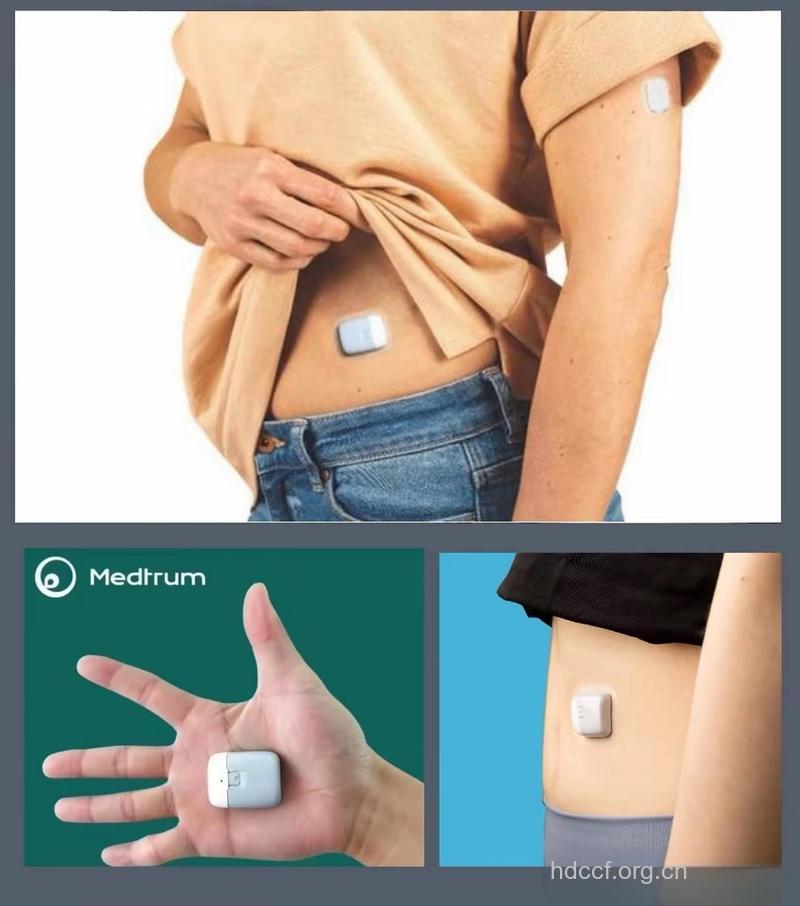 胰岛素泵可用于糖尿病患儿