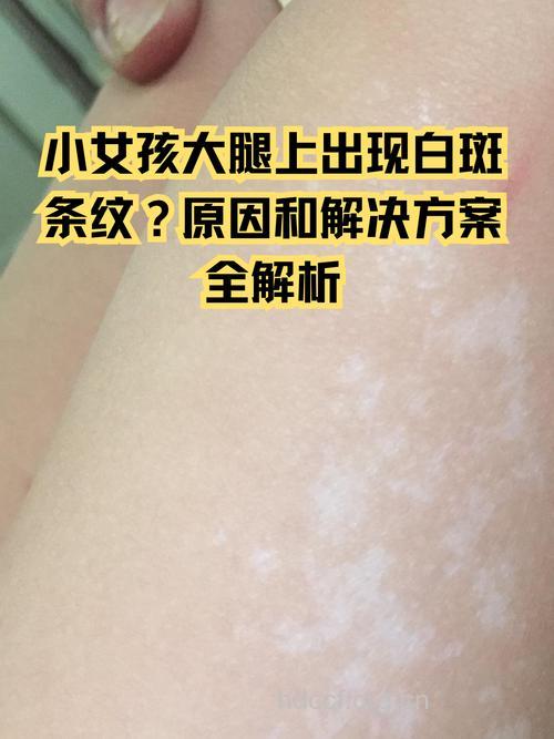 营养障碍致出现白癜风