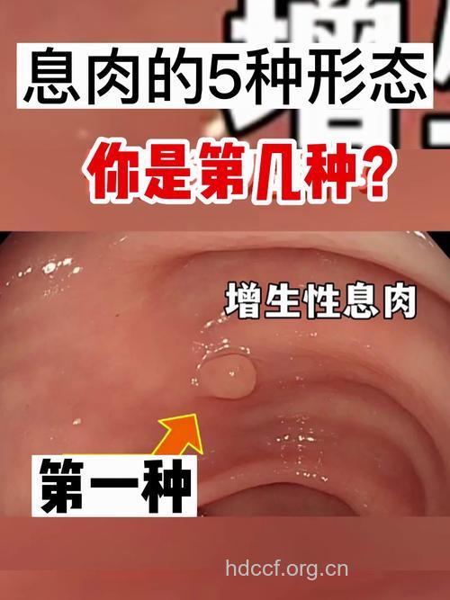 直肠息肉有哪些特征？