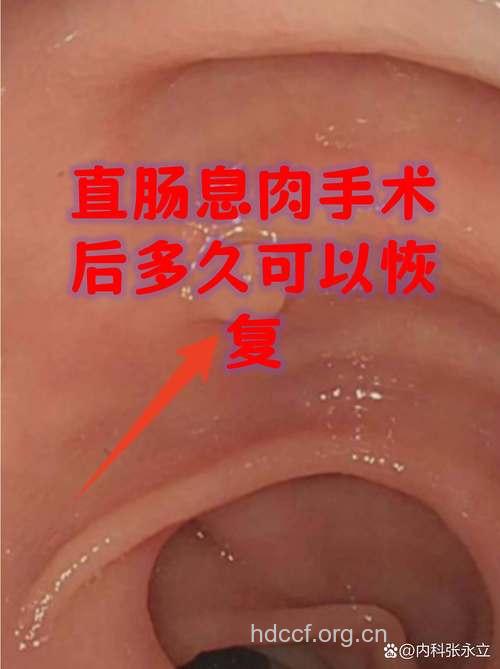 儿童患直肠息肉后需手术治疗吗？