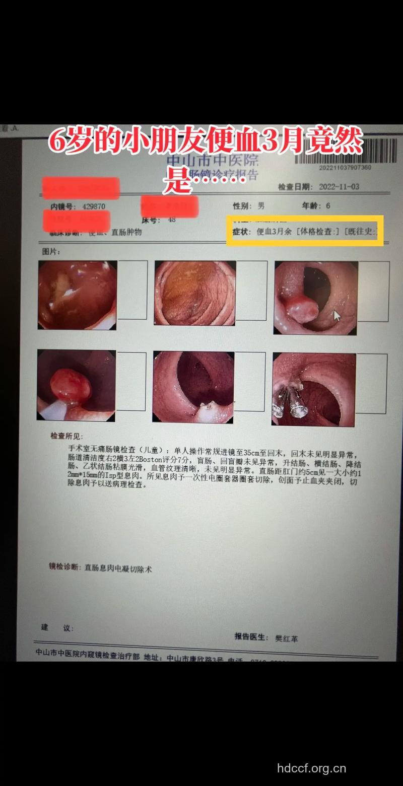 小儿便血也会引起息肉