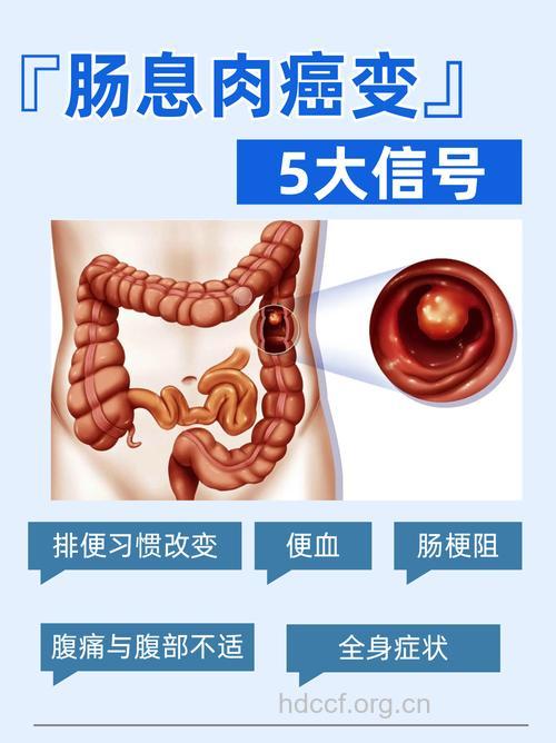 专家:肠息肉不可一切了之