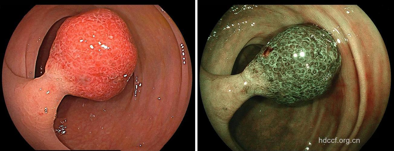 大肠息肉的病变