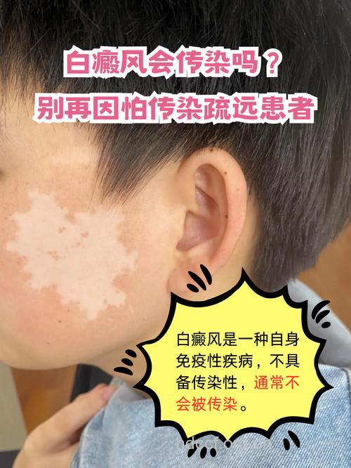 别太害怕白癜风