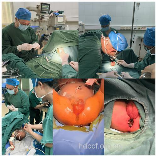 治疗直肠脱垂的手术都有哪些呢?