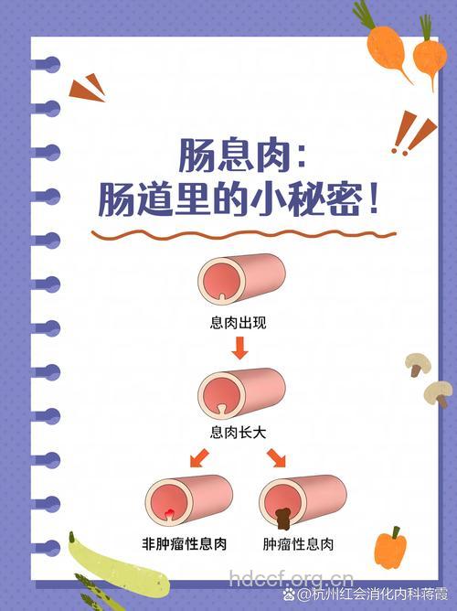 全面剖析：有关直肠息肉　你“知”多少