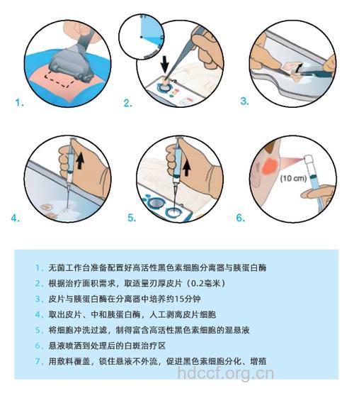 如何利用细胞移植治疗白癜风