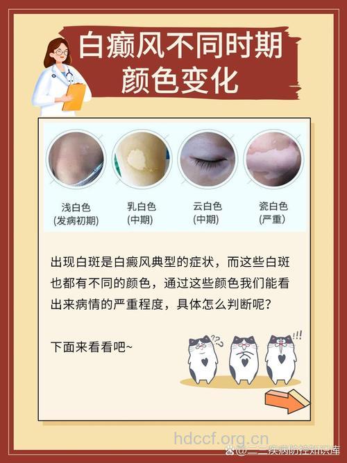 如何区分白化病与白癜风？