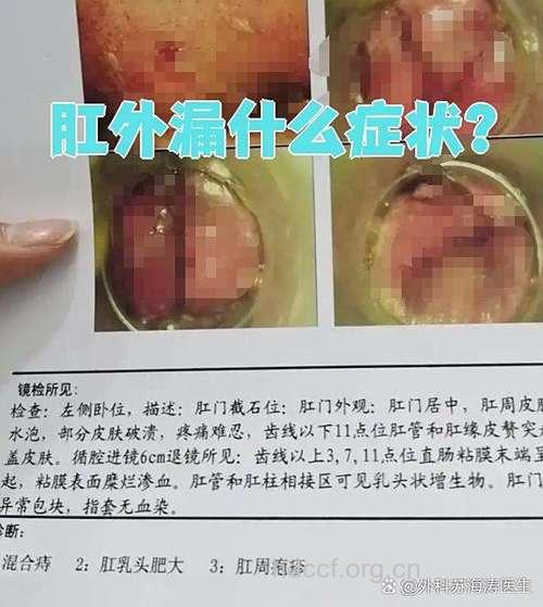 肛门部肿物脱出有哪些疾病呢?