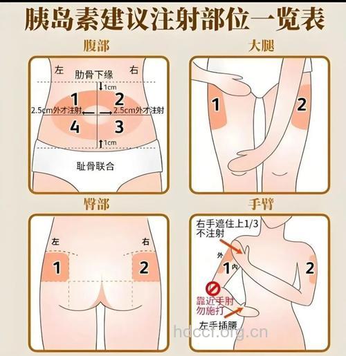 胰岛素注射部位须警惕
