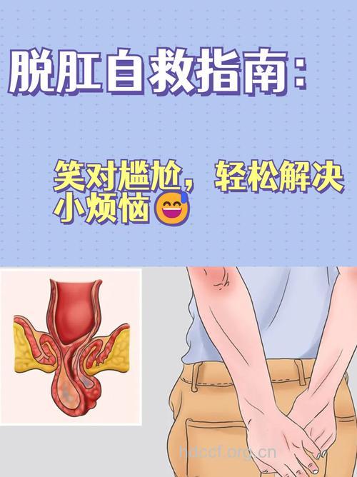 脱肛——炎炎夏天的烦恼