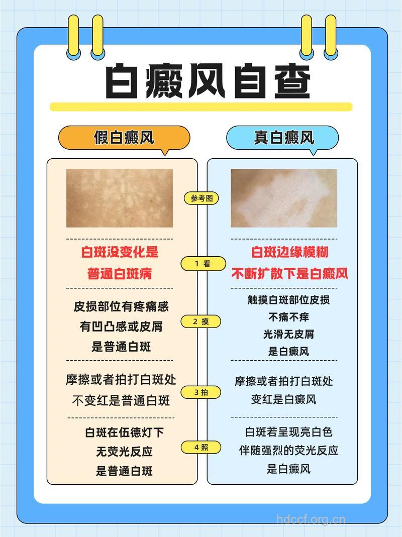 什么是白癜风，能治好吗？