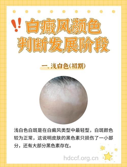 白癜风发病的演变过程