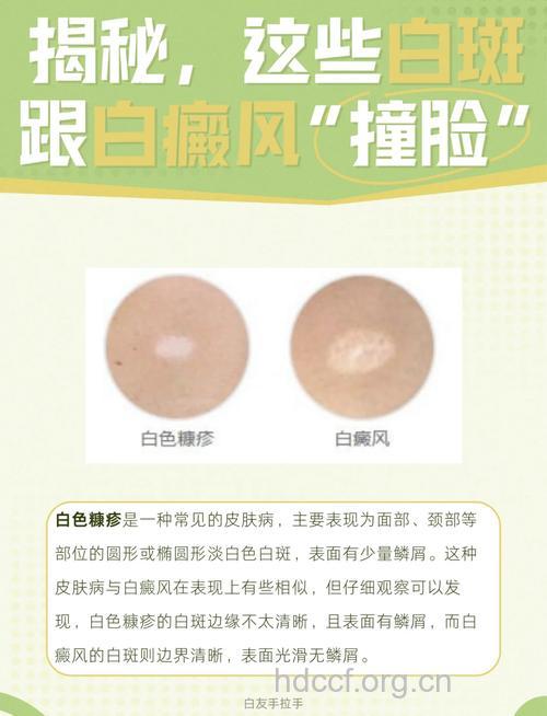 白癜风的发病与什么关系