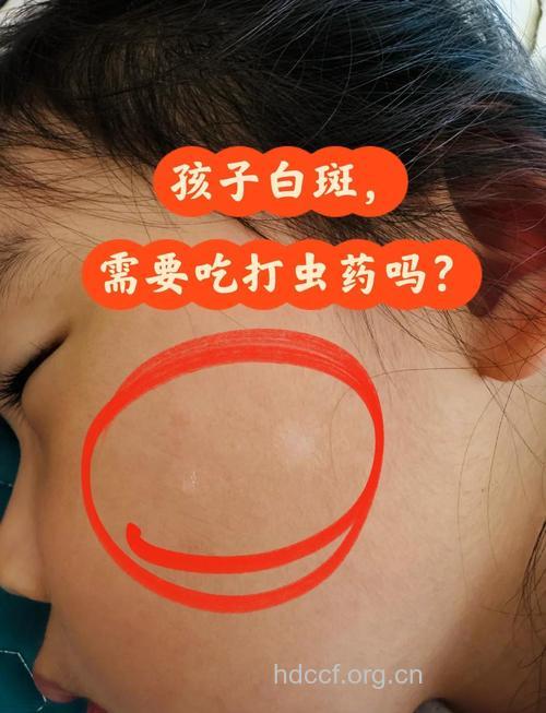 儿童也会得上白癜风吗