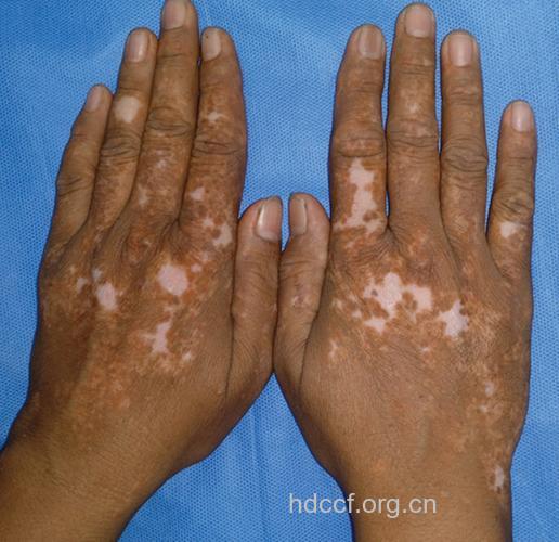 白癜风的三期症状是什么