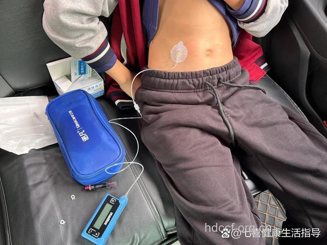 也谈佩戴胰岛素泵的磨合期