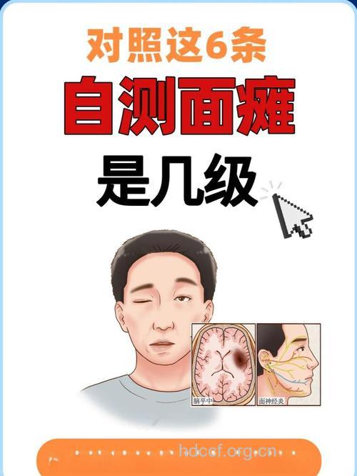 面瘫也可能是癌症的征兆