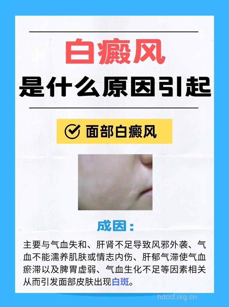 白癜风到底是什么导致的