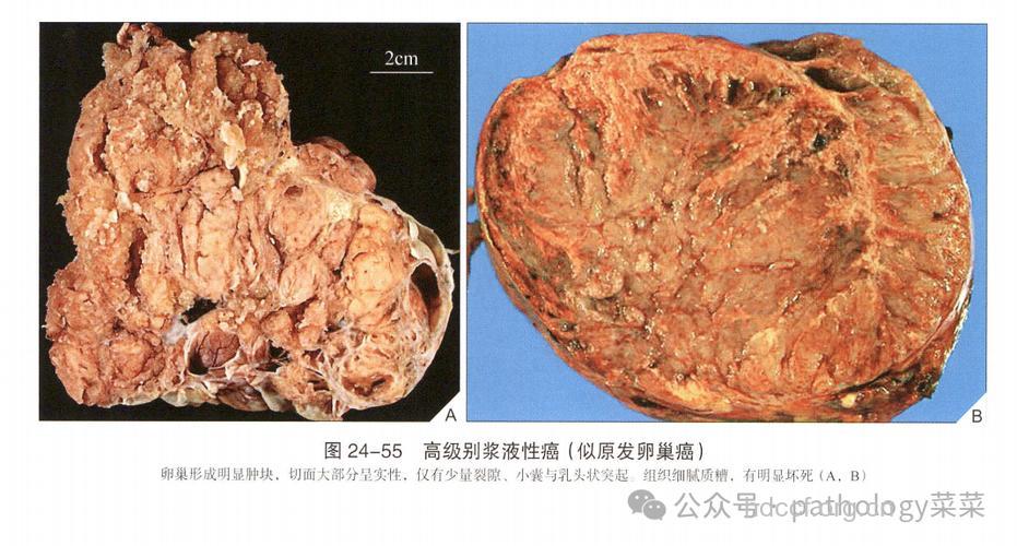 卵巢良性肿瘤的病理特点