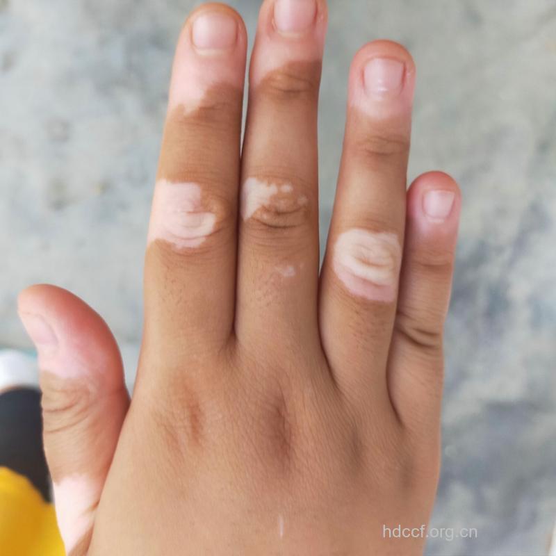 手部白癜风的症状