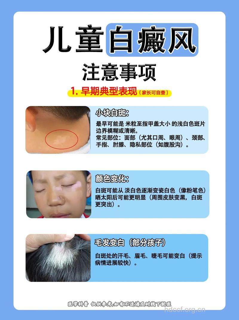 儿童白癜风有哪些特点