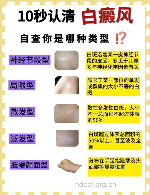 白癜风主要有哪些分类