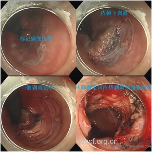 疾病百科 肛管癌是什么样子的