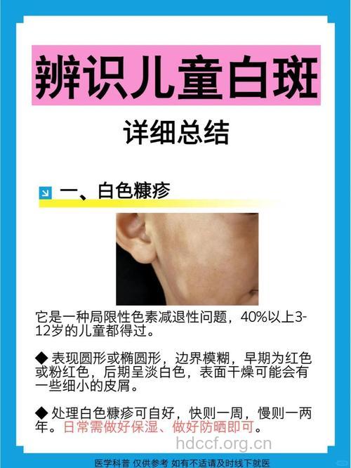 小儿白癜风的治疗有哪些特点