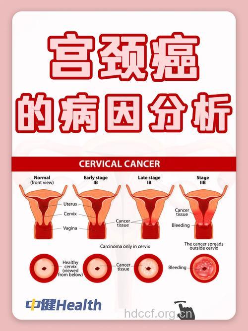 疾病百科 宫颈腺癌是什么疾病