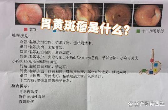 疾病百科 看看胃良性肿瘤是什么