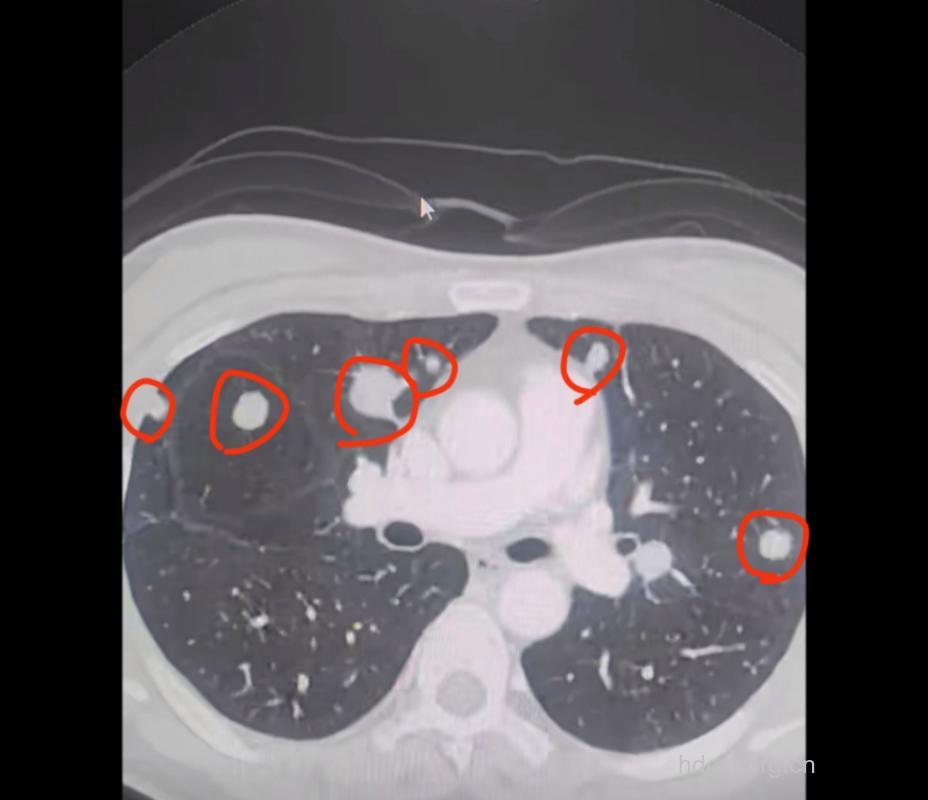 疾病百科 肺转移瘤是什么样子的