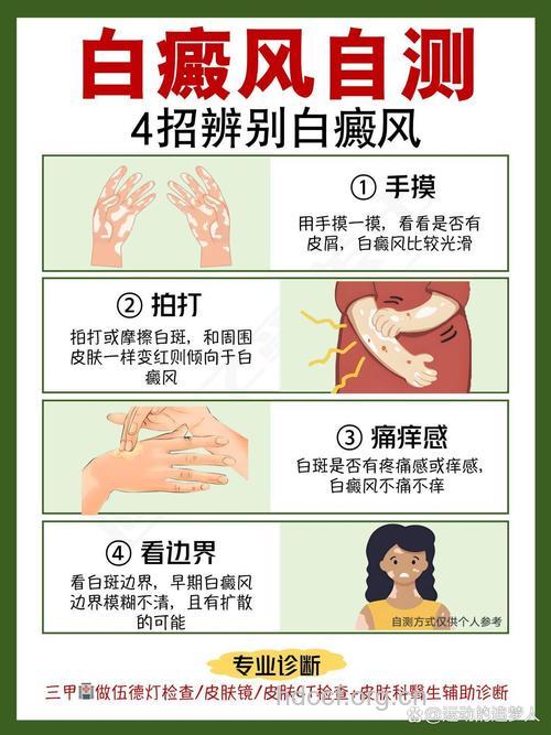 引起白癜风的因素有哪些
