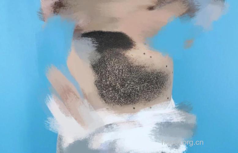 哪些胎记会发生癌变