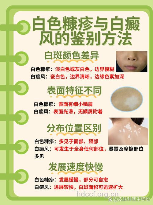 白癜风不仅治皮肤还要治心理