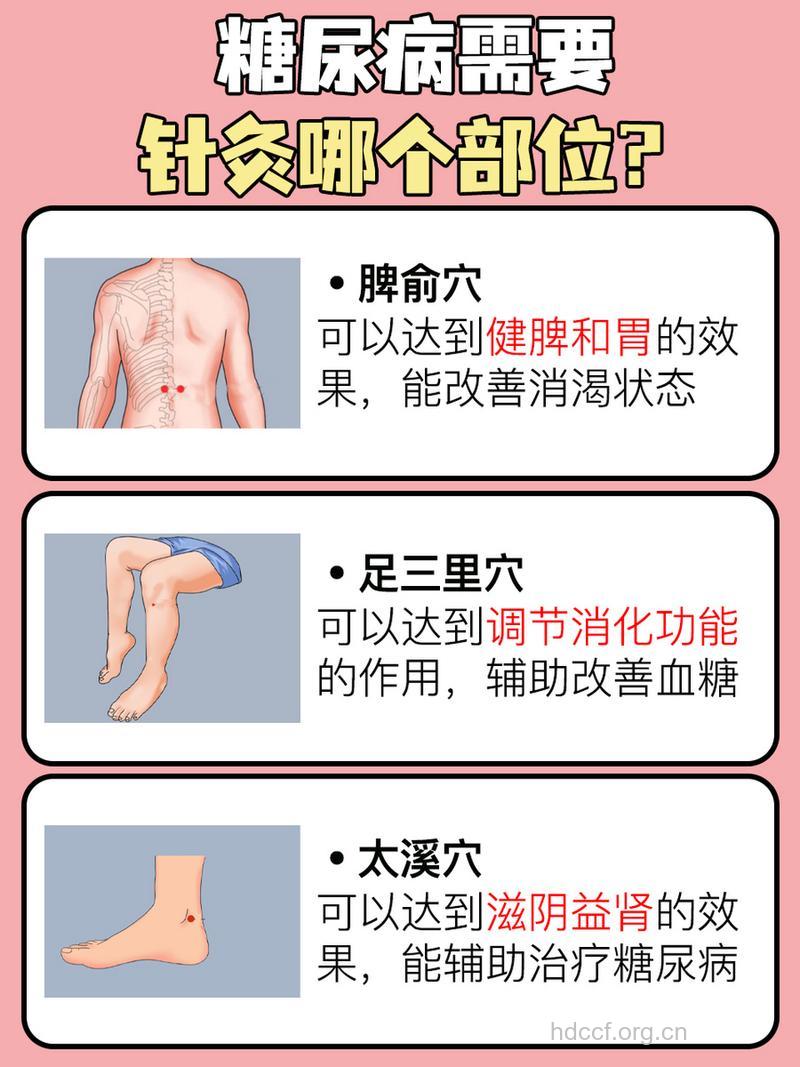 中医针灸治疗糖尿病的方法
