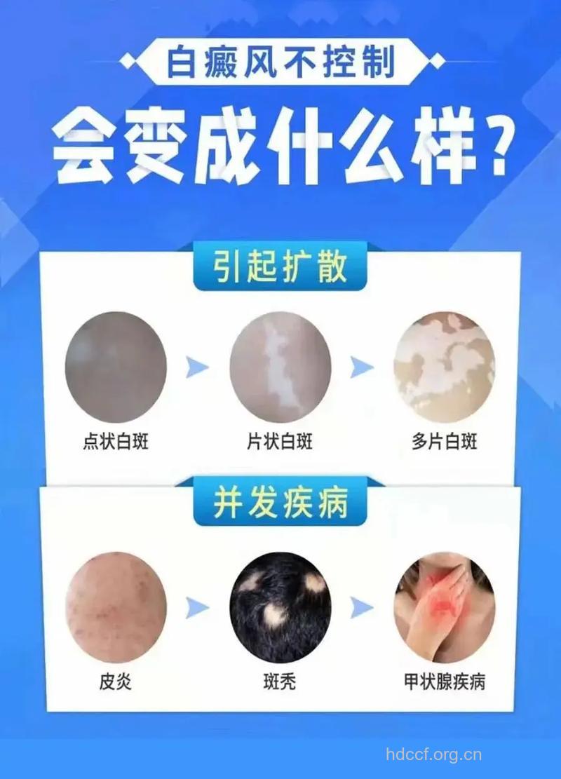 专家告诉我们熬夜容易得白癜风