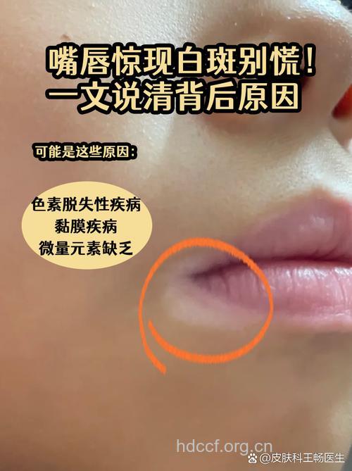 嘴唇有一小块变白就是白癜风吗