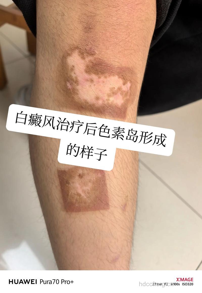 因人而异治疗白癜风