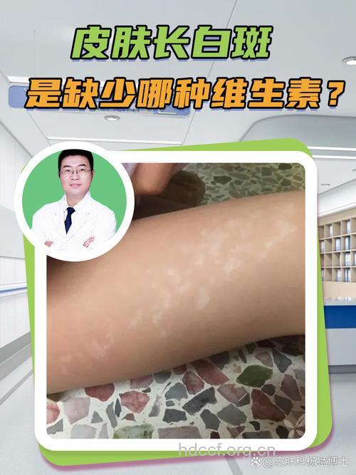营养障碍致出现白癜风病灶